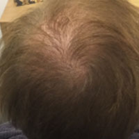 alopecia-androgenetica_3