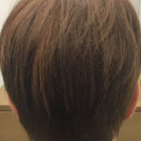 alopecia-androgenetica_4