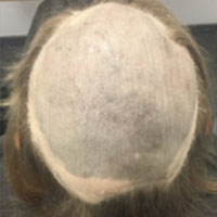 Alopecia 1