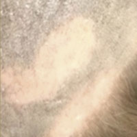 alopecia-areata3